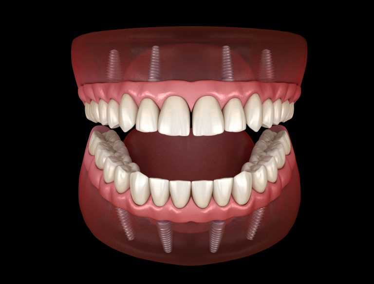 stomatolog-apolonija-zagreb-centar-3D-prikaz-mosta-na-implantatima-s-4-implantata