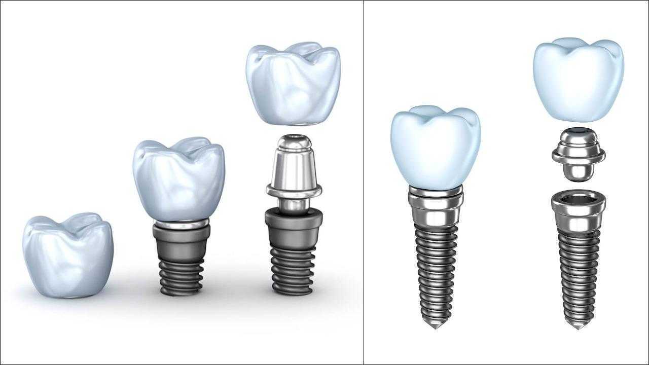 3D-prikaz-dugih-i-kratkih-implantata