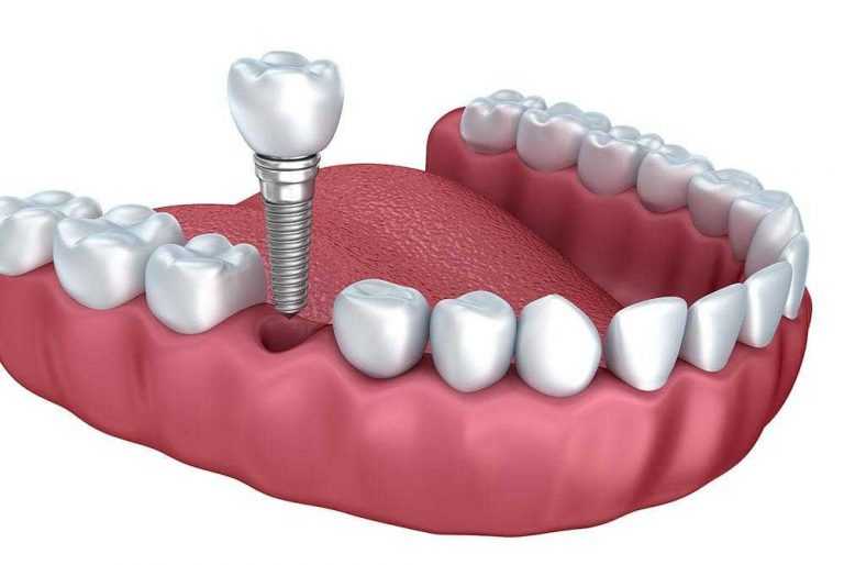 3D-ilustracija-ugradnje-metalnog-implantata-umjesto-jednog-zuba