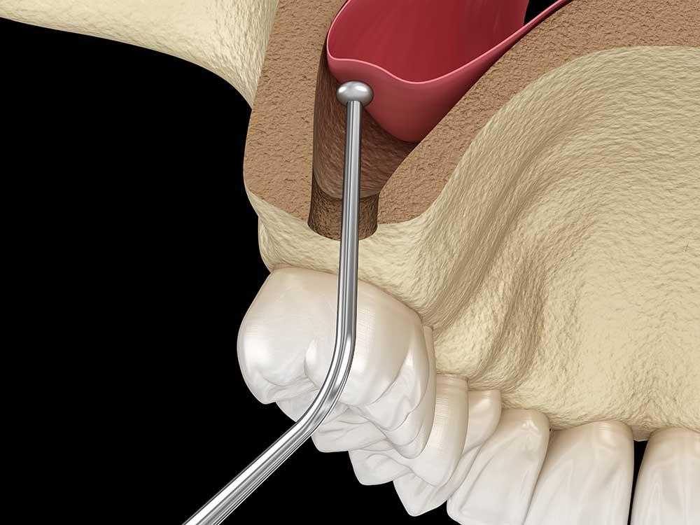 3D-prikaz-operacije-podizanja-sinusa