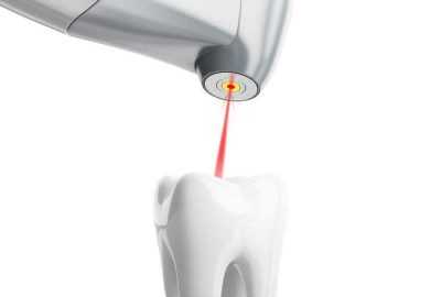 Laseri u stomatologiji