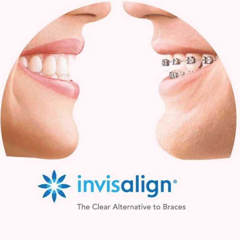 invisalign-i-fiksni-aparatic-usporedba