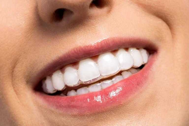 osmijeh-s-invisalign-zubnim-aparaticem