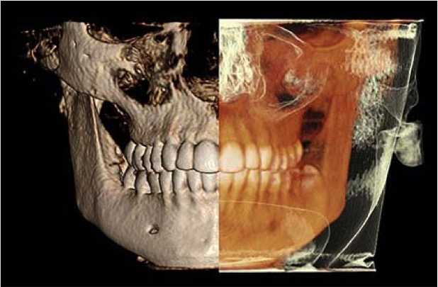 Stomatološka poliklinika Apolonija, Zagreb centar: 3D CBCT snimak koji prikazuje stanje kosti i okolnih tkiva.