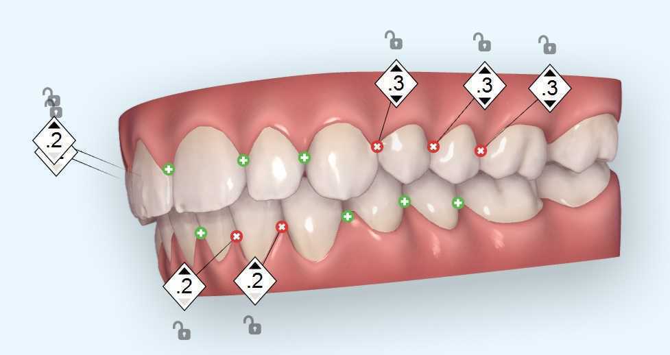 Stomatološka poliklinika Apolonija, Zagreb centar: 3D prikaz plana Invisalign terapije.