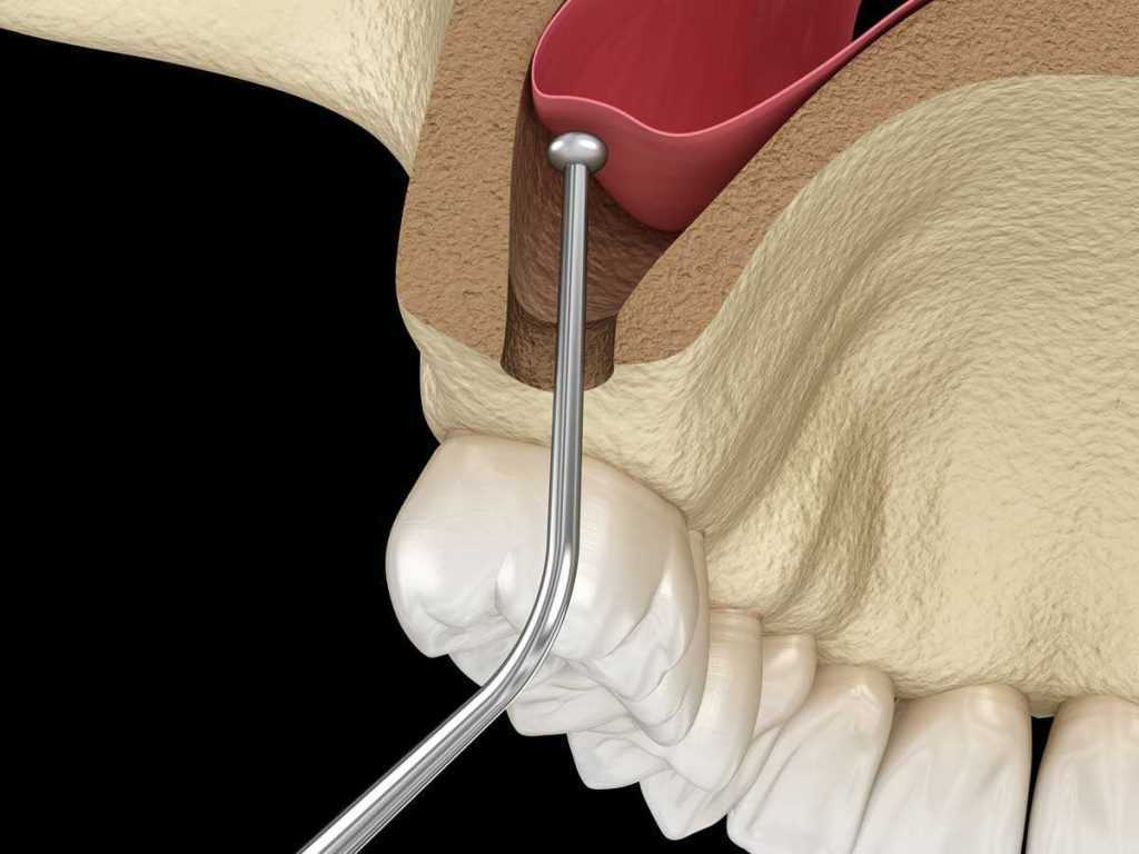 Stomatološka poliklinika Apolonija, Zagreb centar: podizanje sinusa, ili Sinus lift.