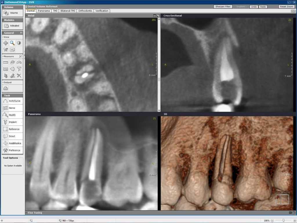 3D posnetek zob, trdega in mehkega tkiva.