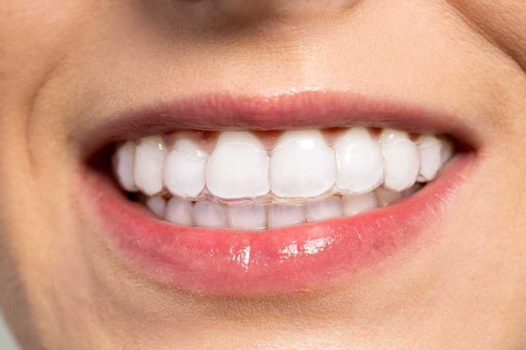 Stomatološka poliklinika Apolonija, Zagreb centar: Invisalign prozirne folije na zubima pacijenta, potpuno su nevidljive Stomatološka poliklinika Apolonija, Zagreb centar: Invisalign prozirne folije na zubima pacijenta, potpuno su nevidljive