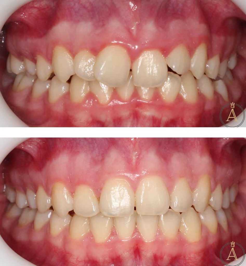 Stomatološka poliklinika Apolonija Zagreb, centar: primjer poboljšanja estetike osmijeha, Invisalign kozmetička terapija, prije-poslije. Stomatološka poliklinika Apolonija Zagreb, centar: primjer poboljšanja estetike osmijeha, Invisalign kozmetička terapija, prije-poslije.