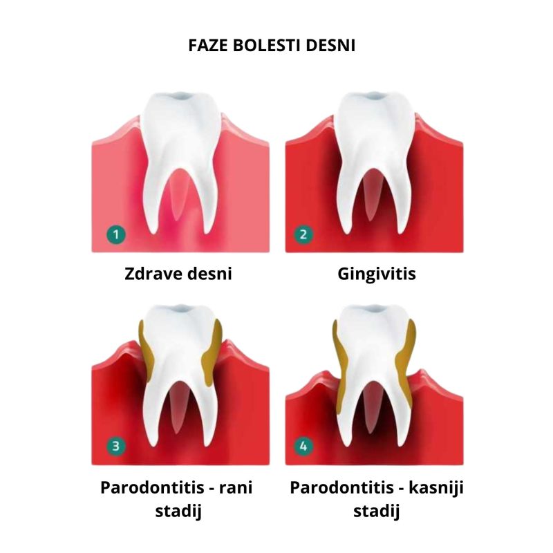 parodontitis